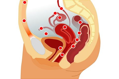 Endometriosis