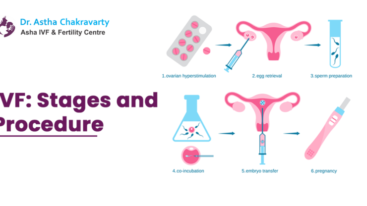 IVF: Stages and Procedure